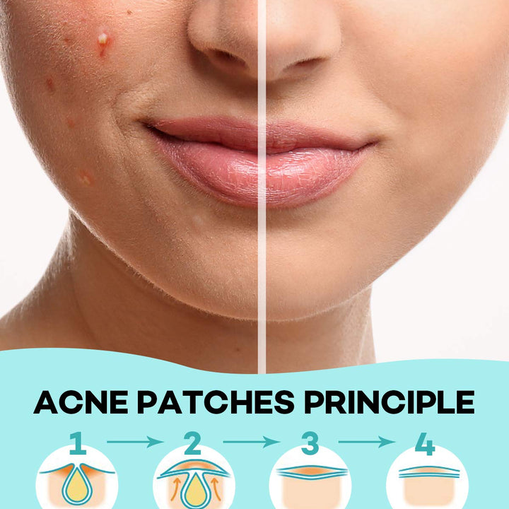 Acne Patch Pimple Patch, 4 Sizes 140 Patches Acne Absorbing Cover Patch, Hydrocolloid Invisible Acne Patches For Face Zit Patch Acne Dots Tea Tree, Calendula Oil